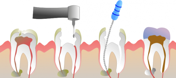 endodontie_1