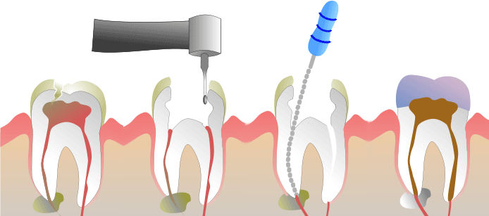 endodontie_1