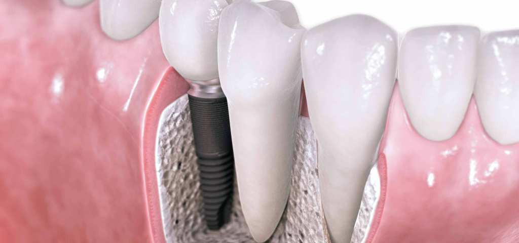 implanturile-dentare