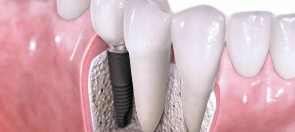 implanturile-dentare